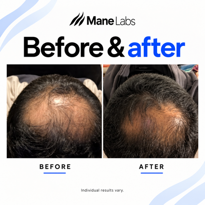 Mane Labs MicroFuse Hair Regrowth Kit